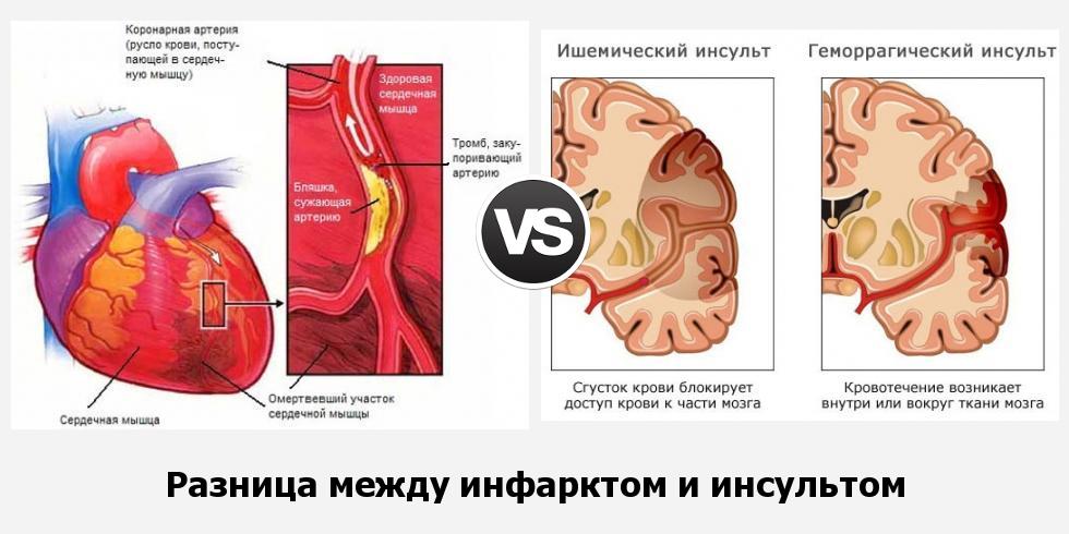 Разница между инфарктом и инсультом